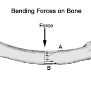 fracture