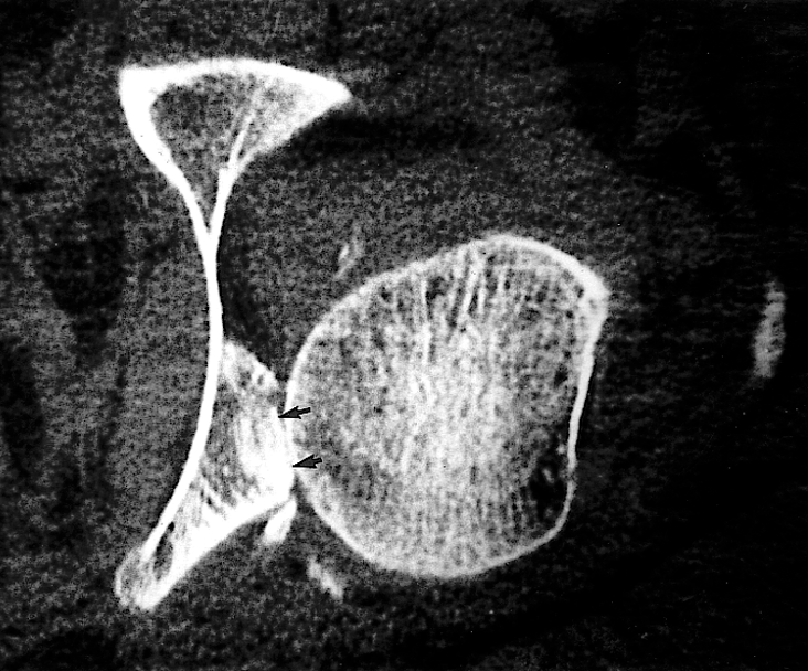 Fracture