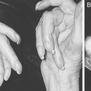 inflammatory-arthritis