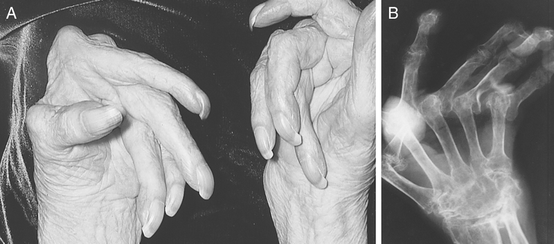Inflammatory Arthritis Inflammatory Arthritis
