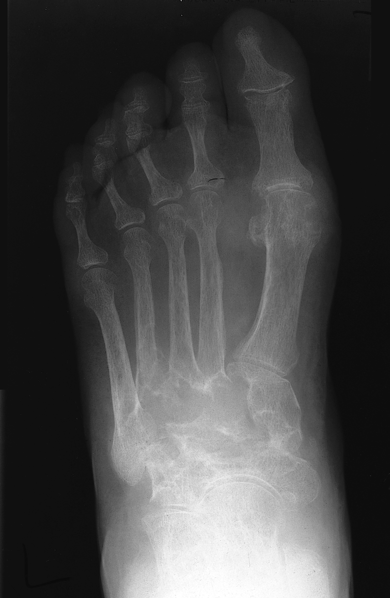 Inflammatory Arthritis