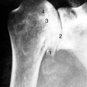 osteoarthritis