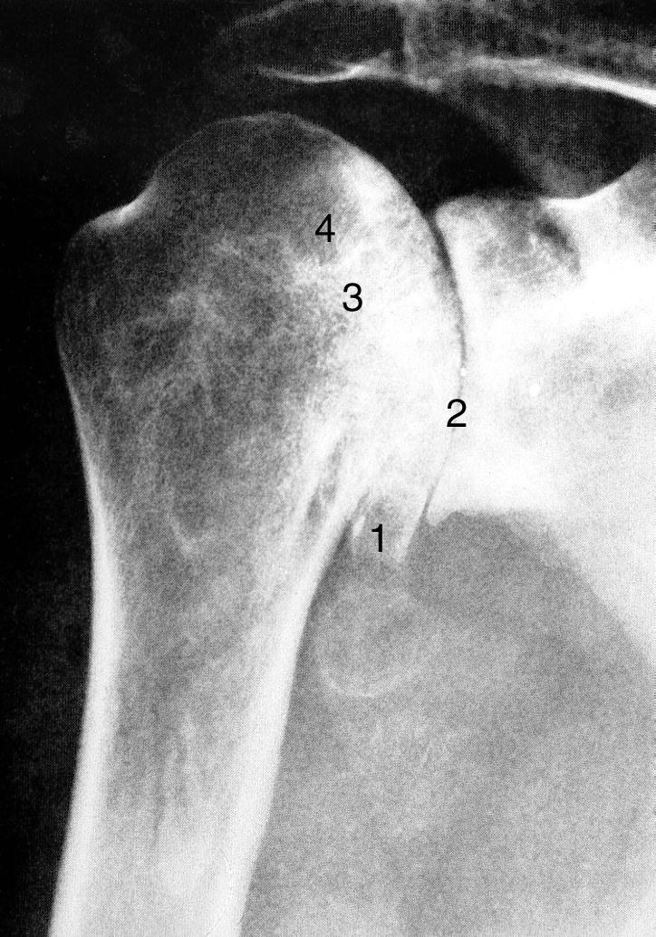 Osteoarthritis Osteoarthritis