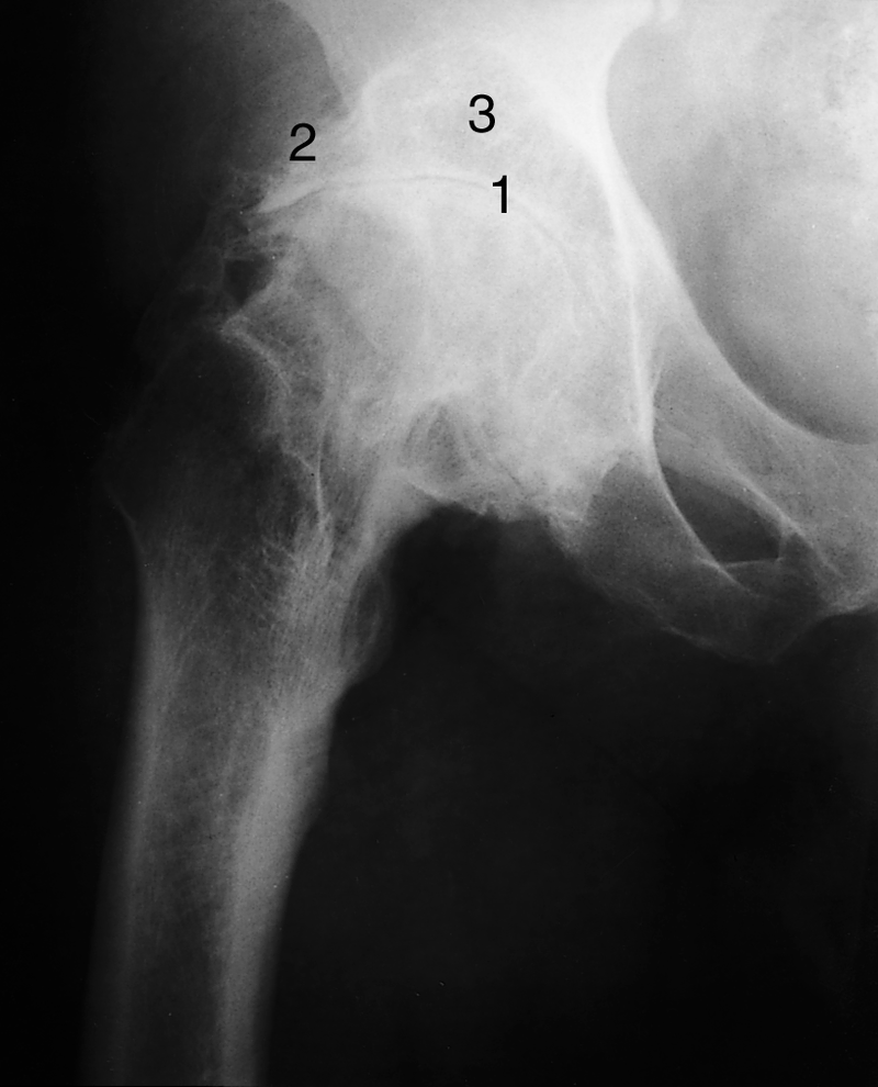 Osteoarthritis Osteoarthritis