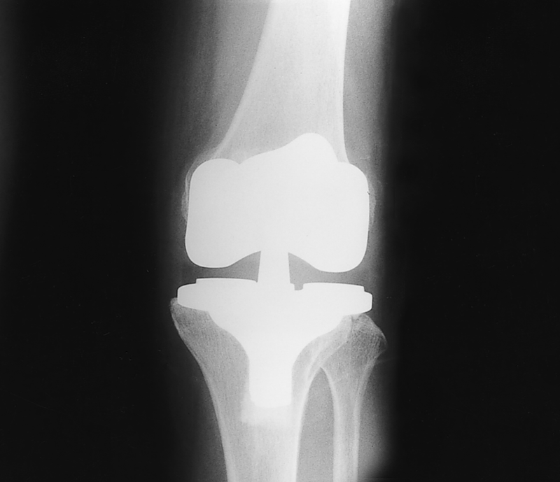 Osteoarthritis Osteoarthritis