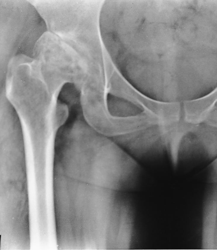 Osteoarthritis Osteoarthritis