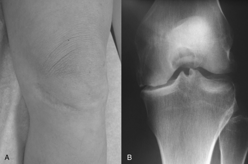 Osteoarthritis Osteoarthritis