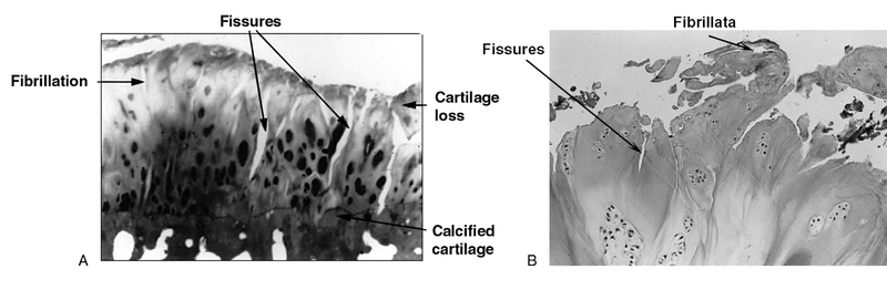 Osteoarthritis