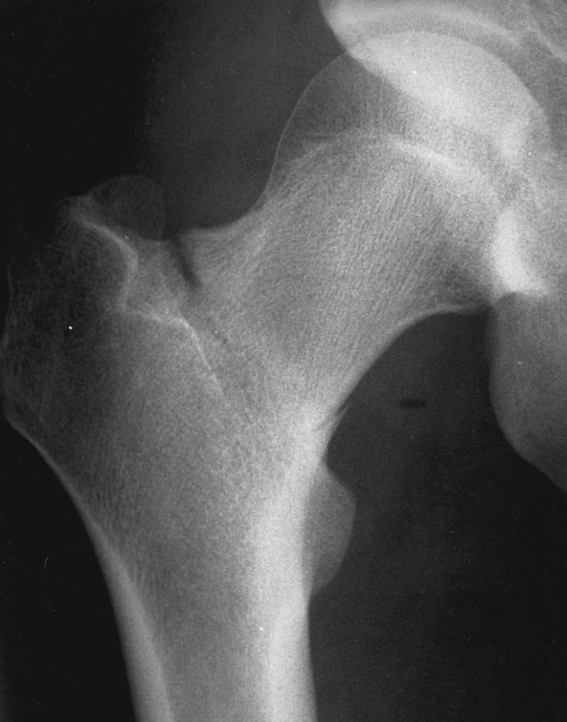 Overuse Injuries
