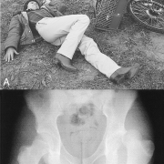 soft-tissue-trauma